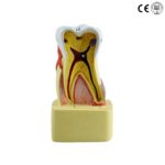 DISEASED TOOTH MODEL