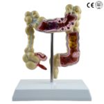 DISEASED LARGE INTESTINES MODEL