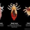 Preserved Louse Specimen 5/Pack