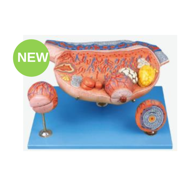 Enlarged Ovary 8-Part Model